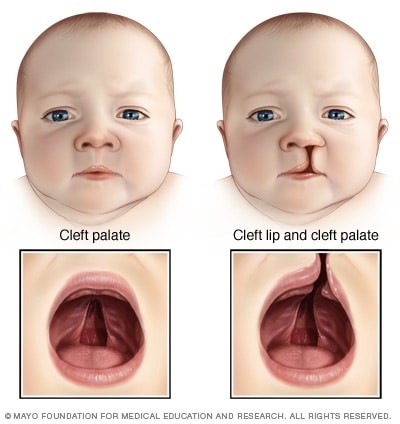 Cleft palate on infant