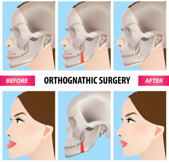 orthognathic surgery - before and after