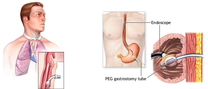 Tracheostomy and PEG Tube