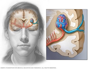brain arteriovenous malformation (AVM)