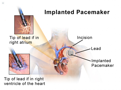 Implanted pacemaker image. 